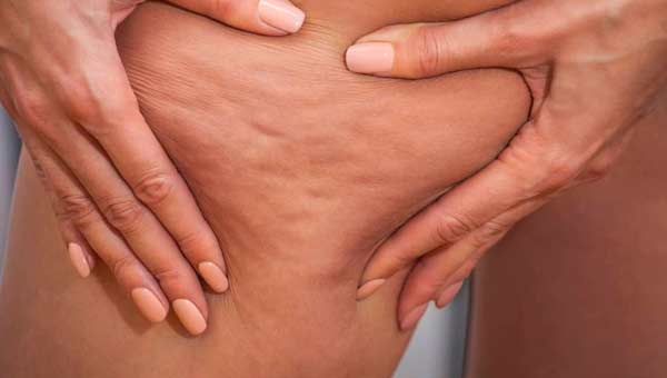 Миф: Целлюлит – это болезнь.